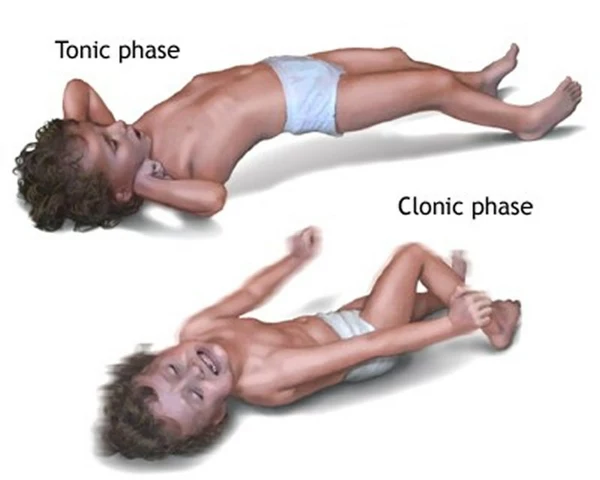 The different phases of a tonic-clonic seizure explained